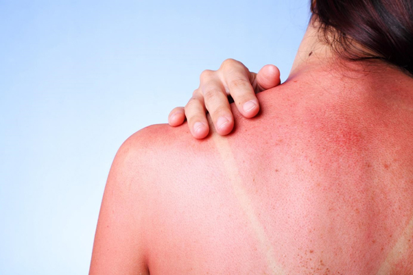 how to treat sunburn fast
