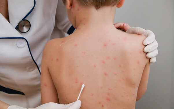 chicken pox how to treat