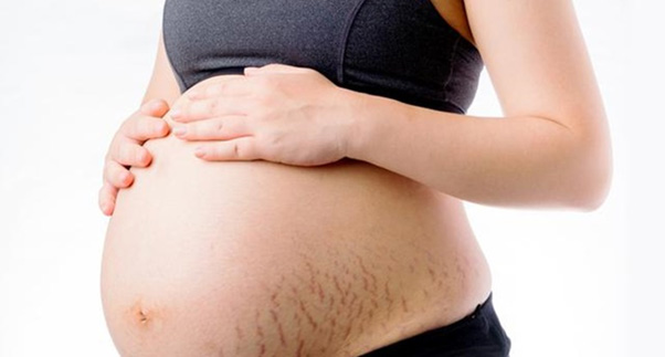 stretch marks during pregnancy skin care